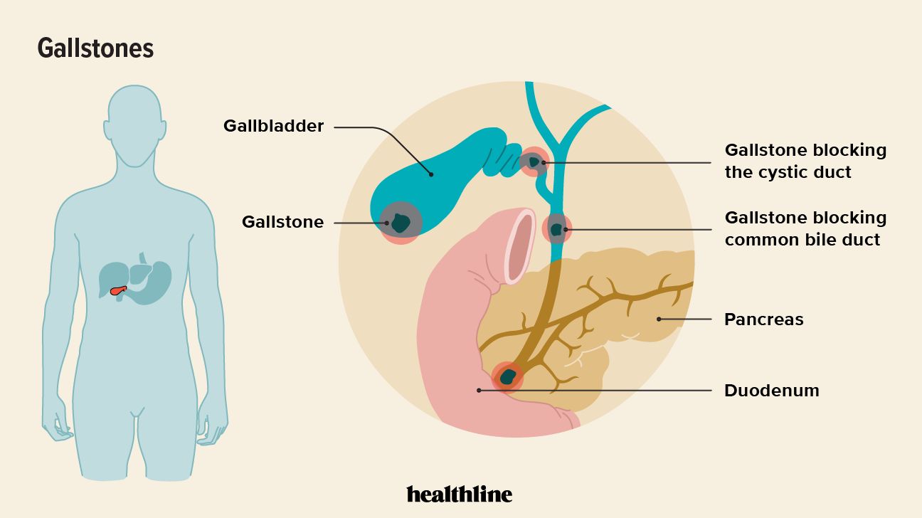 Gallstone illustration