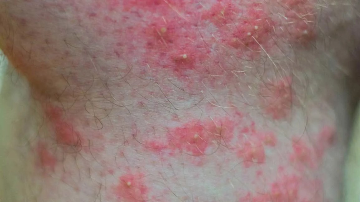 Fire ant stings are swollen red spots that develop a blister on top