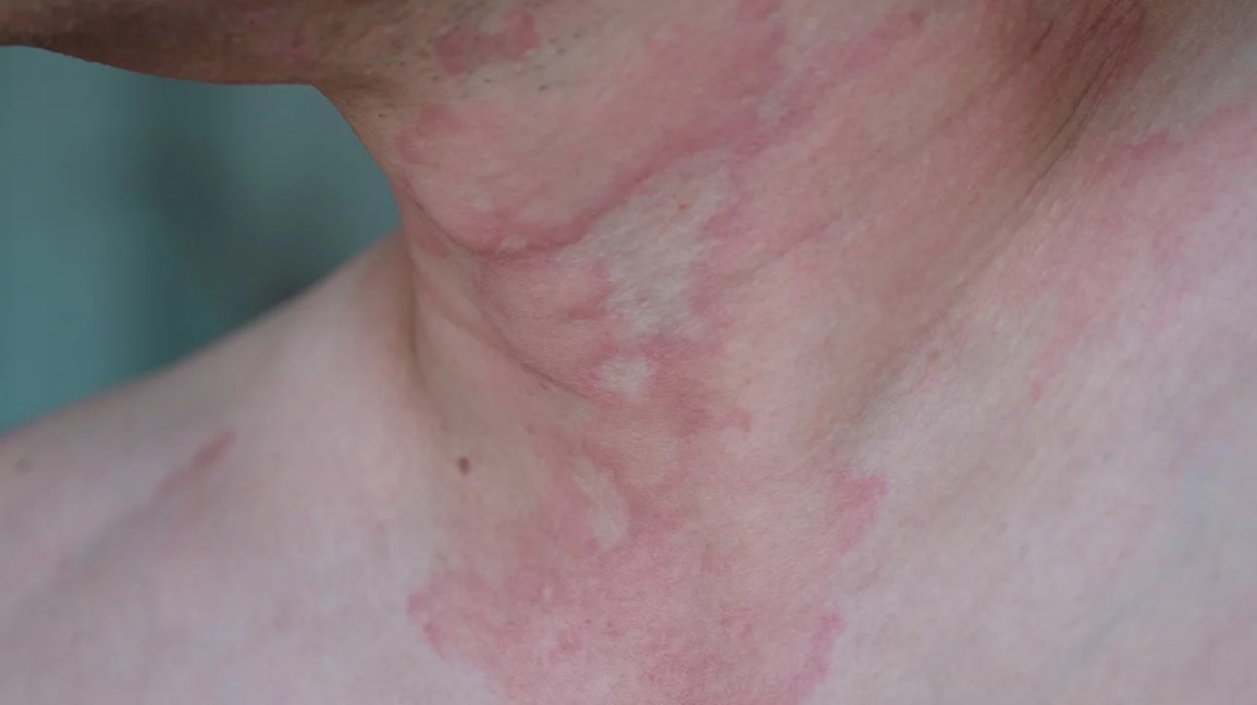 Inflamed rash