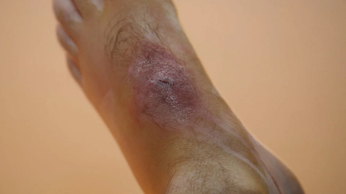 hobo spider bite on foot