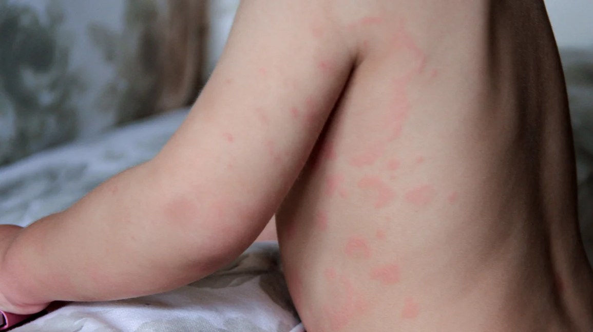 Hives on child