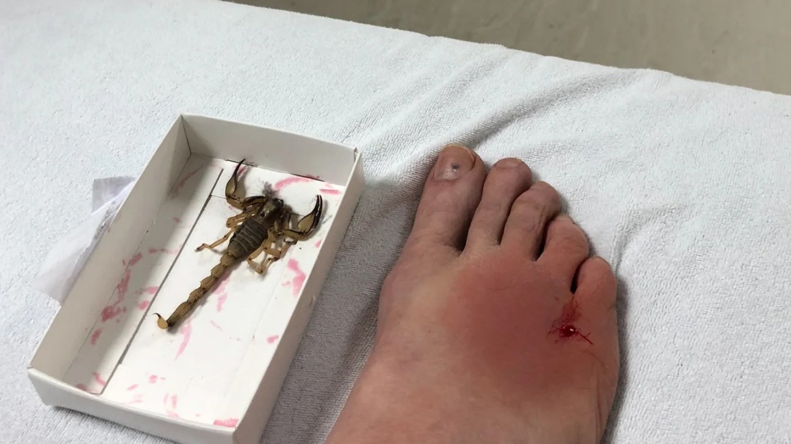 scorpion sting on foot next to dead scorpion in box