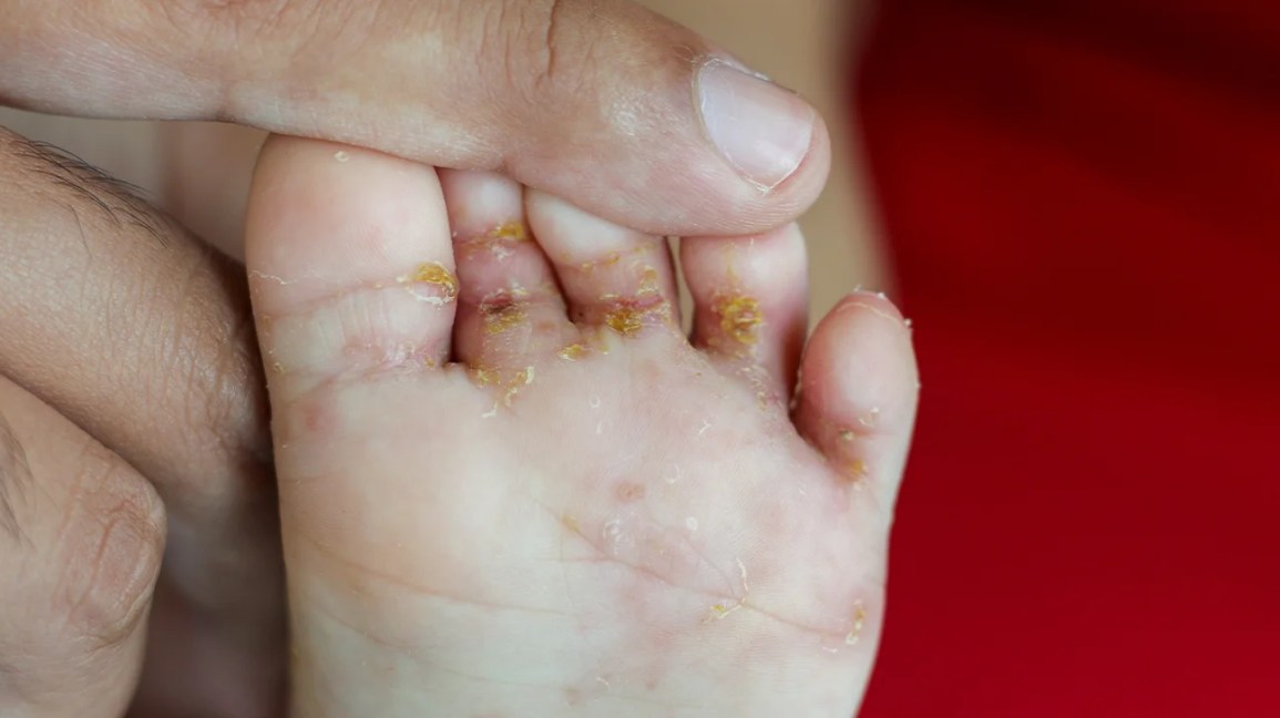 scabies on child's toes