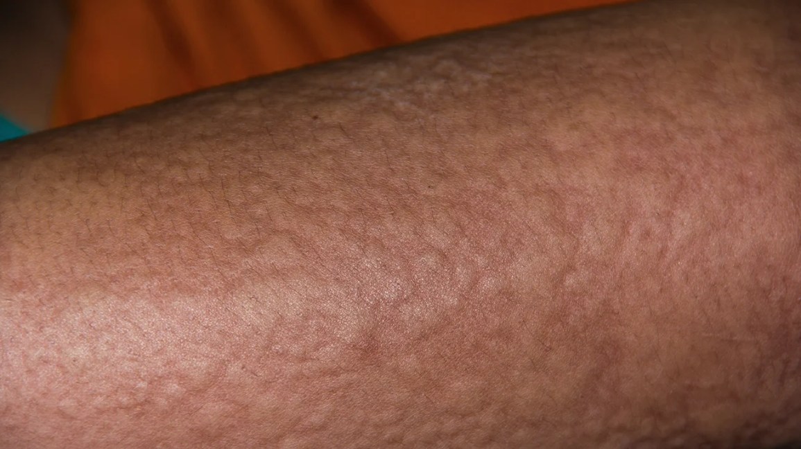 Allergic reaction on skin
