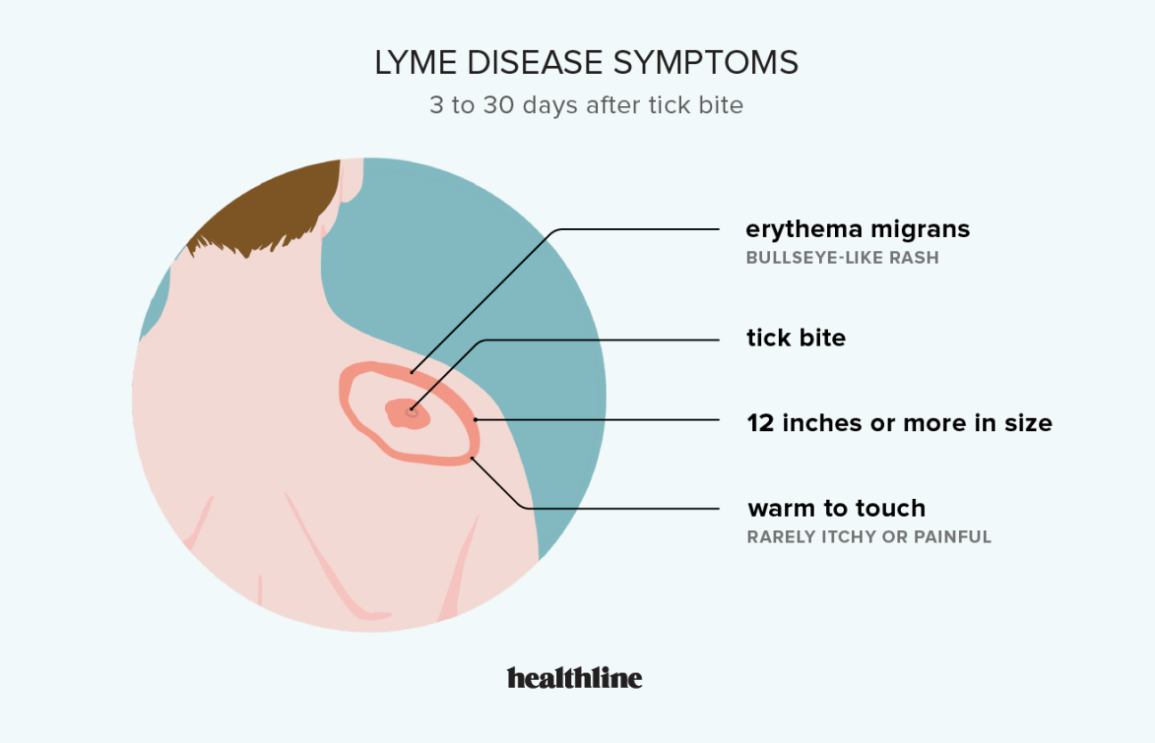 lyme disease early symptoms info graphic with bulls-eye rash